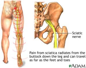 All about Sciatica - what is sciatica, how to treat the pain and exercises to prevent it